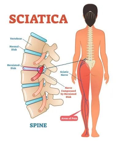 Diagram of sciatica: a herniated disc in the lower spine compressing the sciatic nerve, with the areas of pain marked down the leg